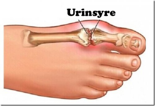 urinsyre