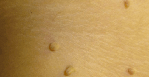 10 naturlige midler for fjerning av vorter