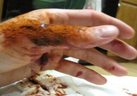 En gelé som stopper blødninger på bare 10 sekunder