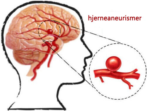 Hvordan oppdage og forebygge aneurismer