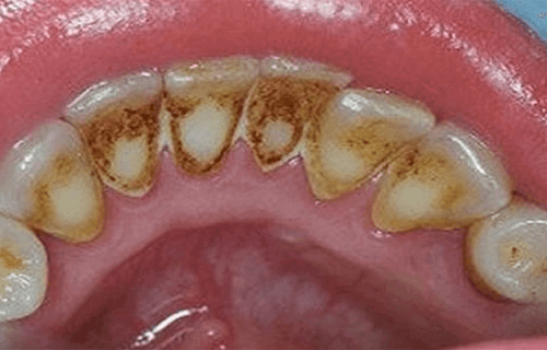 Forebygge plakk for bedre tannhelse