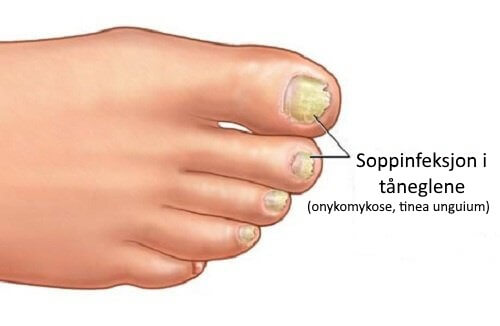 Hjemmelagde behandlinger mot soppinfeksjoner