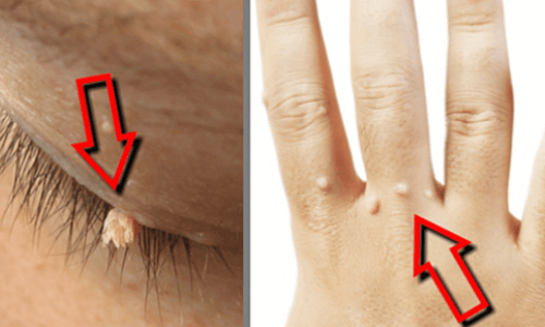 Naturlig fjerning av vorter