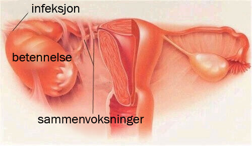 Symptomer på akutt bekkeninfeksjon