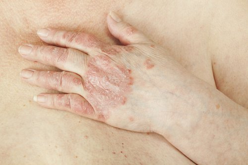 Hvordan kan man behandle psoriasis?