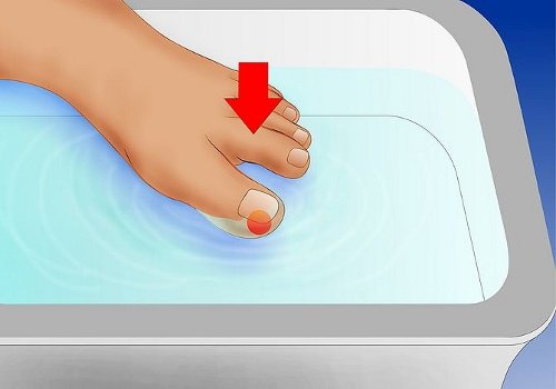 Hvordan behandle inngrodde tånegler