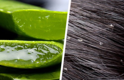 Effektive og enkle tips mot flass