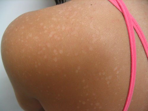 Hva forårsaker hvite flekker i huden?