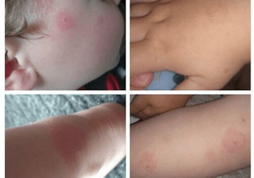 Risikoer med borreliose