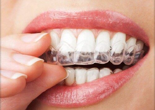 4 behandlinger mot sliping eller sammenbiting av tennene