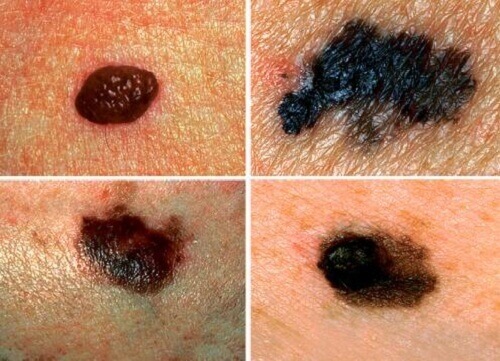 Hvordan oppdage hudkreft?