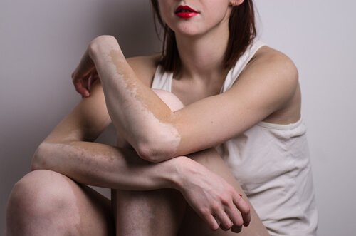 1-vitiligo-armer