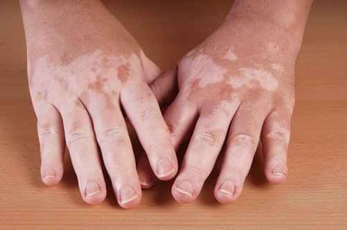 5 hjemmeremedier for vitiligo 5 hjemmeremedier for vitiligo