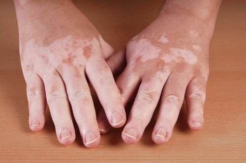 5 hjemmeremedier for vitiligo