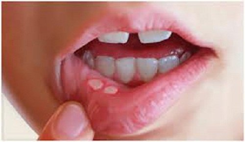 Munnskåld og munnsår