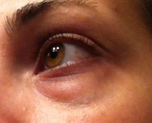 Hvordan behandle ringer under øynene naturlig