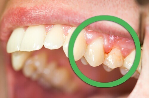Naturlige måter å behandlige gingivitt på