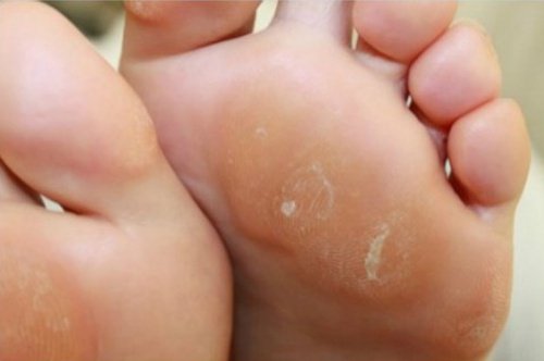 Naturlig krem mot hard hud på føttene