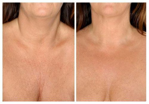 Naturlige hudpleiebehandlinger for halsen din Naturlige hudpleiebehandlinger for halsen din
