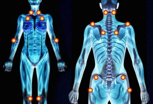 5-Fibromyalgi