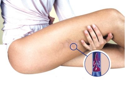 Åreforkalkning i ekstremitetene: hva er symptomene?