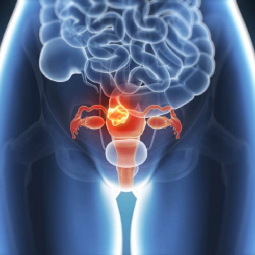 Endometriose, en stille sykdom: Risikoer og symptomer