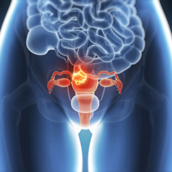 Risikoer og symptomer ved endometriose, en stille sykdom Risikoer og symptomer ved endometriose, en stille sykdom