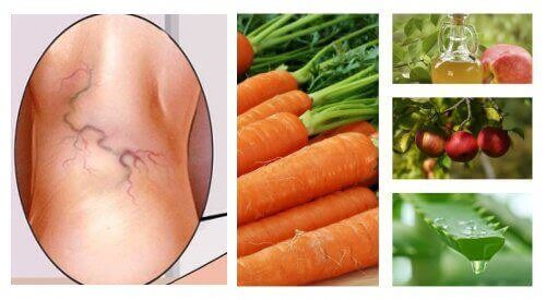 Åreknuter - Naturlig behandling med 3 ingredienser