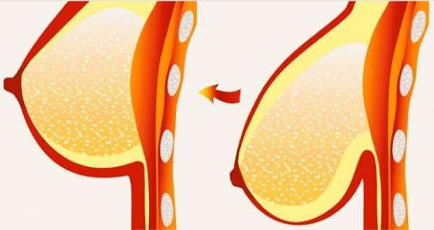 8 tips og behandlinger for slappe bryster