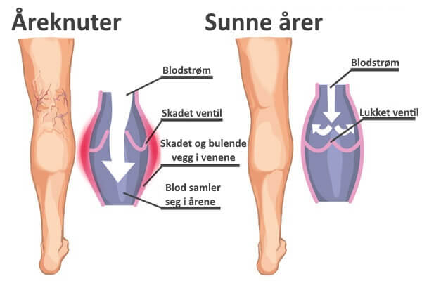 3-areknuter-sunne-arer