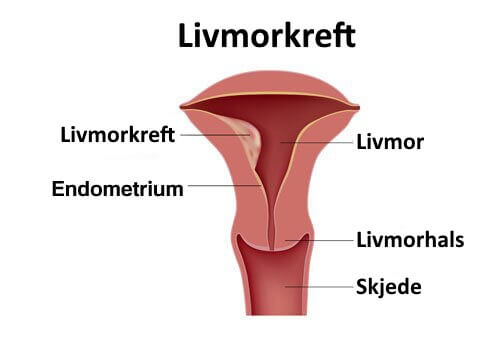 livmorkreft-1
