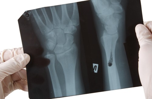 Matvarer som skader skjelettet ditt