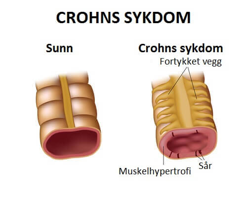 Behandling av Crohns sykdom med riktig kosthold