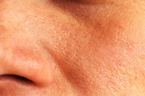 Naturlige behandlinger mot forstørrede porer