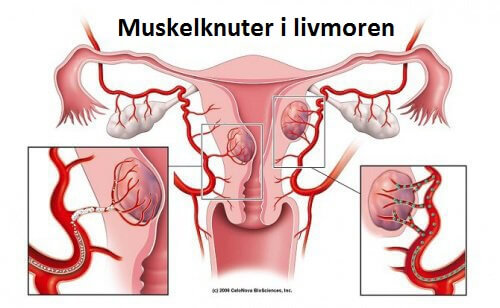 Muskelknuter i livmoren: 5 ting du må vite