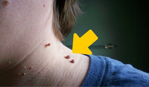 Fjerne hudfliker naturlig: Vi gir deg 6 tips