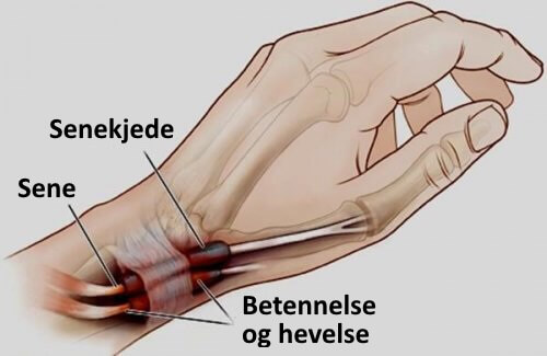 Tenosynovitt: Betennelse i hender og føtter