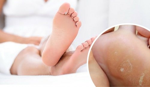 Bli kvitt træler på føttene dine med denne effektive behandlingen