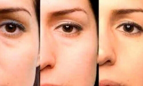 Råd for å bli kvitt poser under øynene