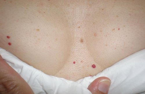 Røde flekker på huden: Bør du være bekymret?