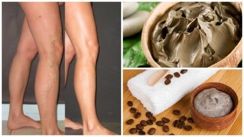 5 naturlige måter å bekjempe åreknuter på