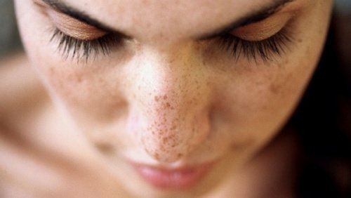 6 naturlige behandlinger for å bli kvitt mørke flekker i ansiktet