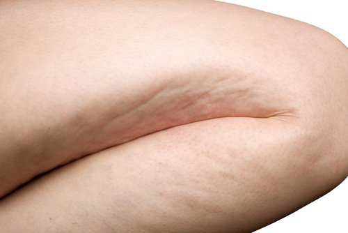 6 øvelser for å effektivt bekjempe cellulitter