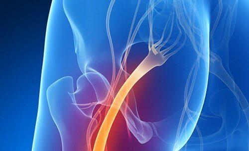 5 måter å finne ut om du har symptom på isjias
