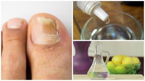 Bekjemp neglesopp naturlig med 3 ingredienser