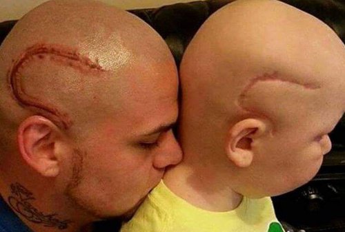 En far fikk tatovering av sønnens arr etter kreft