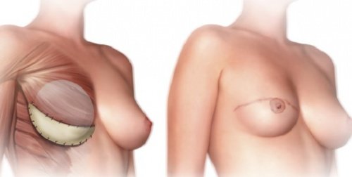 Hva bør du vite før en mastektomi?