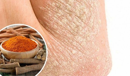 7 naturlige måter å bekjempe psoriasis på