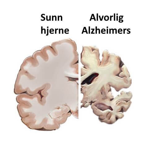 Tidlig diagnostisering av Alzheimers gjennom tale