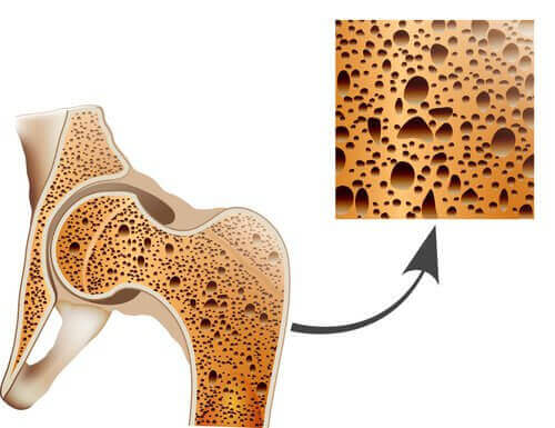 Bekjemp din osteoporose med disse naturlige remediene